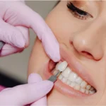 Veneers