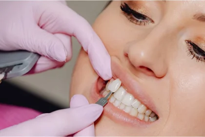 Veneers