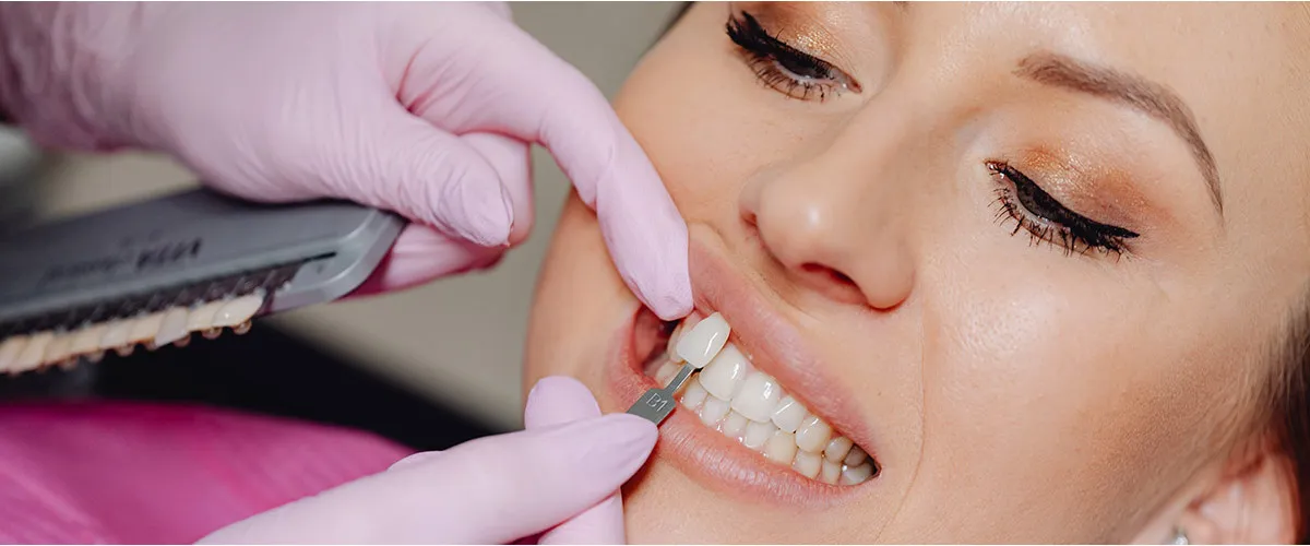 Veneers